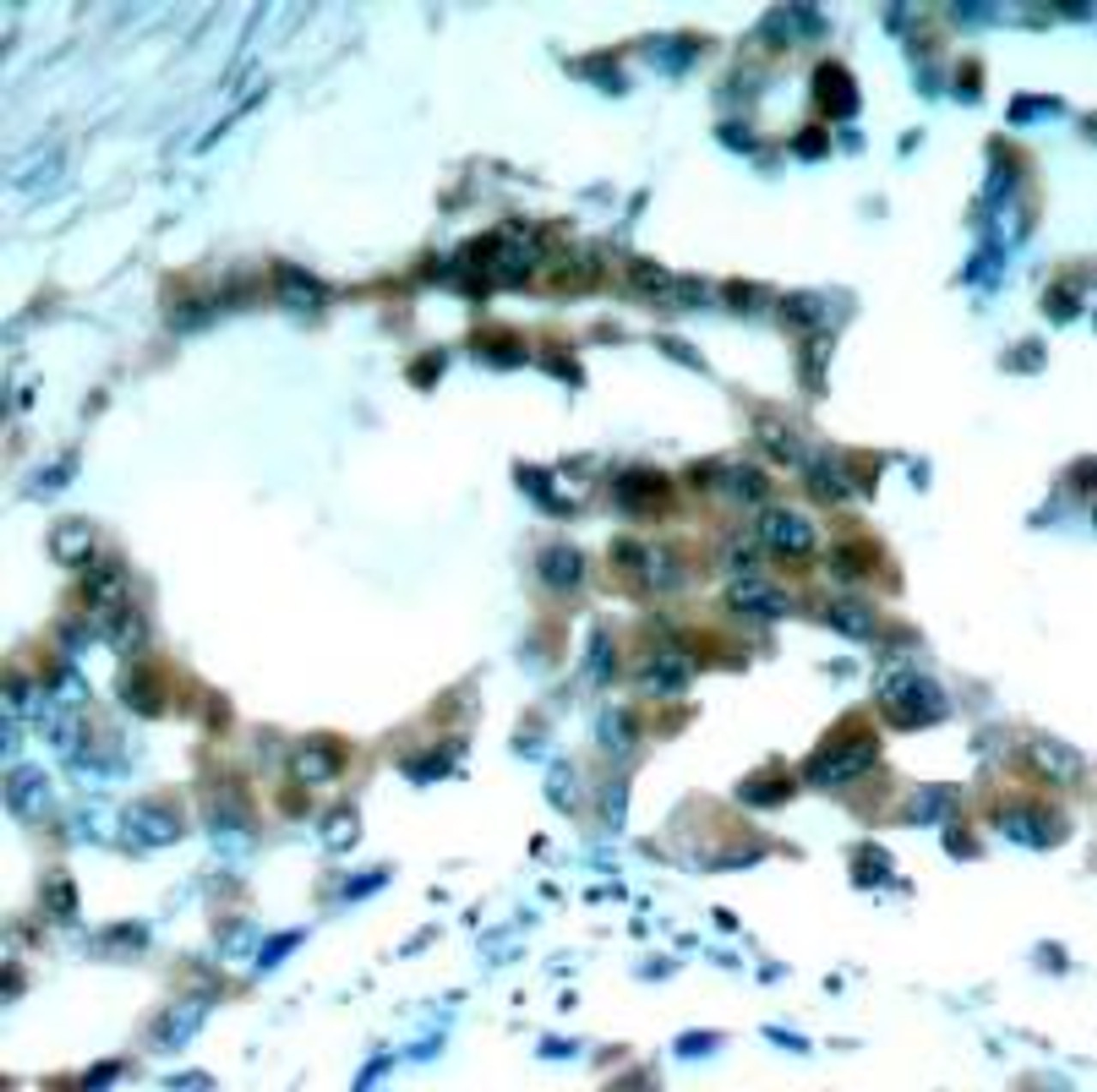 Immunohistochemical analysis of paraffin-embedded human lung carcinoma tissue using PKC&#920; (Phospho-Ser695) .