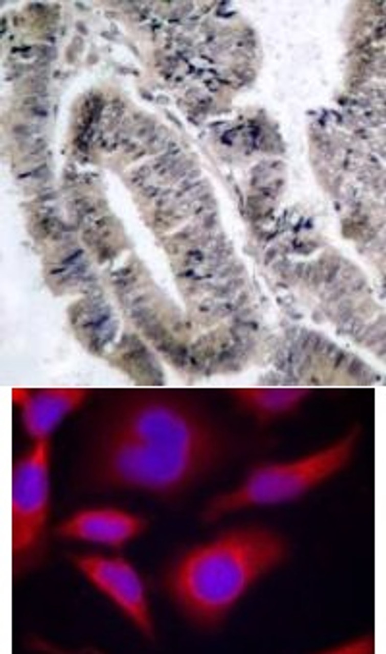 <b>Top Image:</b> Immunohistochemical analysis of paraffin-embedded human colon carcinoma tissue using AMPK&#945;1 (Phospho-Ser487) .<b>Bottom Image:</b> Immunofluorescence staining of methanol-fixed HeLa cells using AMPK&#945;1 (Phospho-Ser487) Antibody #11174.