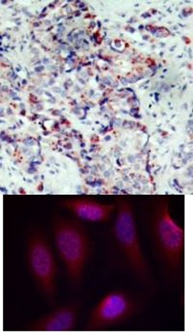 <b>Top Image:</b> Immunohistochemical analysis of paraffin-embedded human breast carcinoma tissue using SEK1/MKK4 (Phospho-Ser80) .<b>Bottom Image:</b> Immunofluorescence staining of methanol-fixed HeLa cells using SEK1/MKK4 (Phospho-Ser80) .