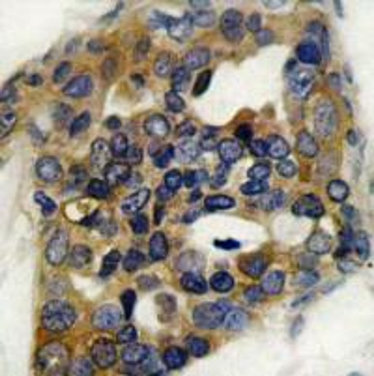 Immunohistochemical analysis of paraffin-embedded human breast carcinoma tissue using ASK1 (Phospho-Ser966) .