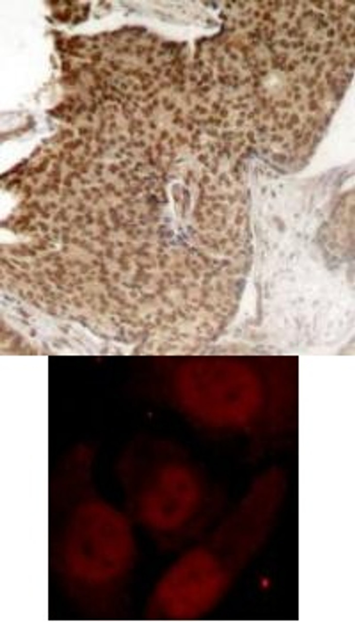 <b>Top Image:</b> Immunohistochemical analysis of paraffin-embedded human breast carcinoma tissue using HDAC2 (Phospho-Ser394) .<b>Bottom Image:</b> Immunofluorescence staining of methanol-fixed HeLa cells showing nuclear staining using HDAC2 (Phospho-Ser394) .