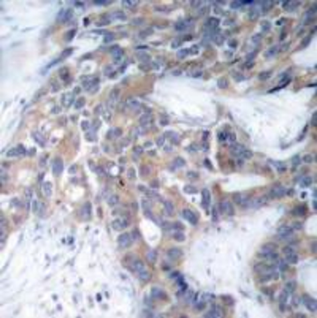 Immunohistochemical analysis of paraffin-embedded human breast carcinoma tissue using MEK1/MEK2 (Phospho-Ser217/Ser221) .