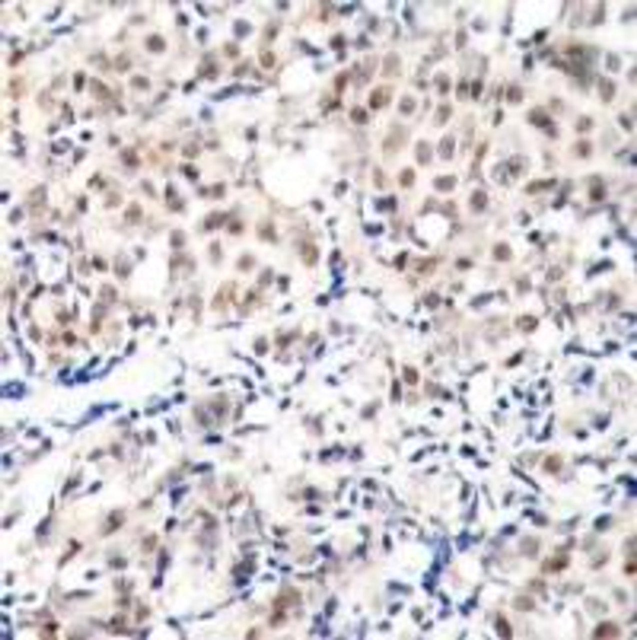 Immunohistochemical analysis of paraffin-embedded human breast carcinoma tissue using p27Kip1 (Phospho-Thr187) .