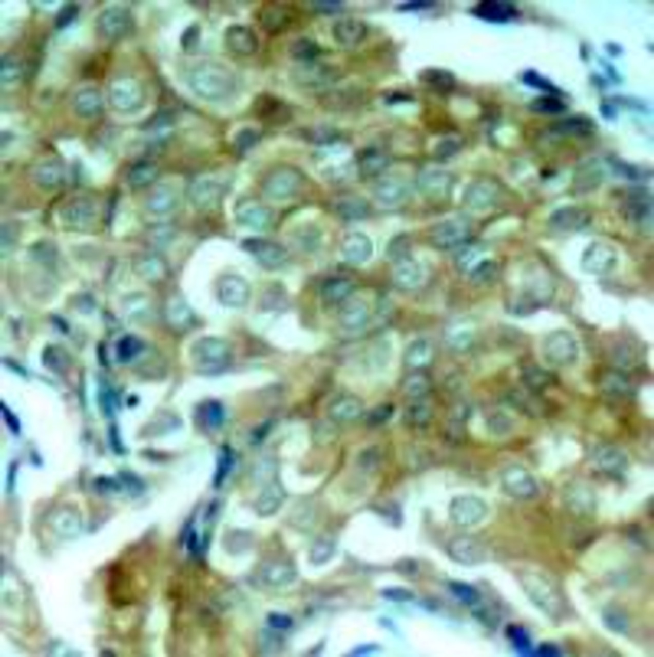 Immunohistochemical analysis of paraffin-embedded human breast carcinoma tissue using EGFR (Phospho-Tyr1172) .