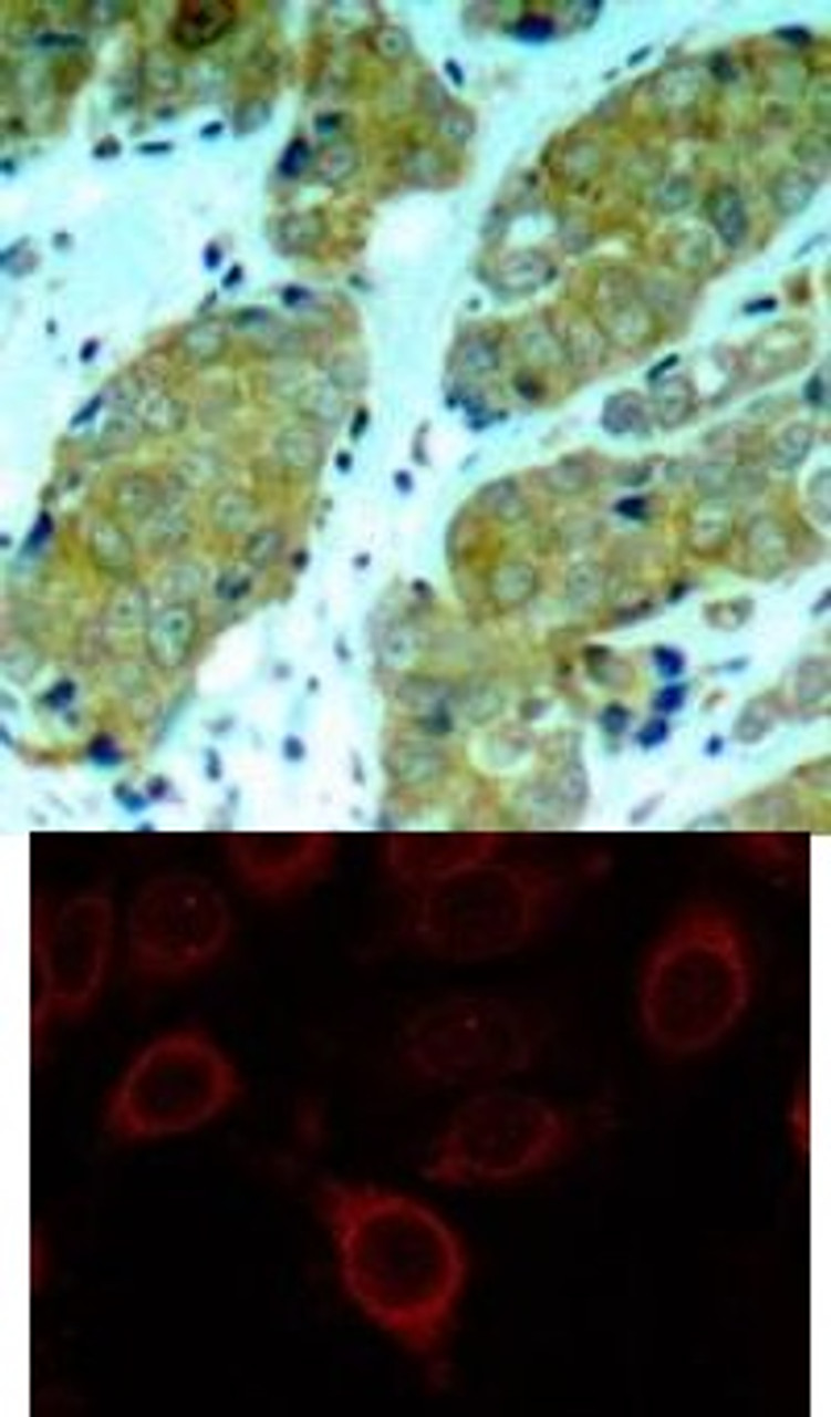 <b>Top Image:</b> Immunohistochemical analysis of paraffin-embedded human breast carcinoma tissue using mTOR (Phospho-Ser2448) .<b>Bottom Image:</b> Immunofluorescence staining of methanol-fixed MCF cells using mTOR (Phospho-Ser2448) .
