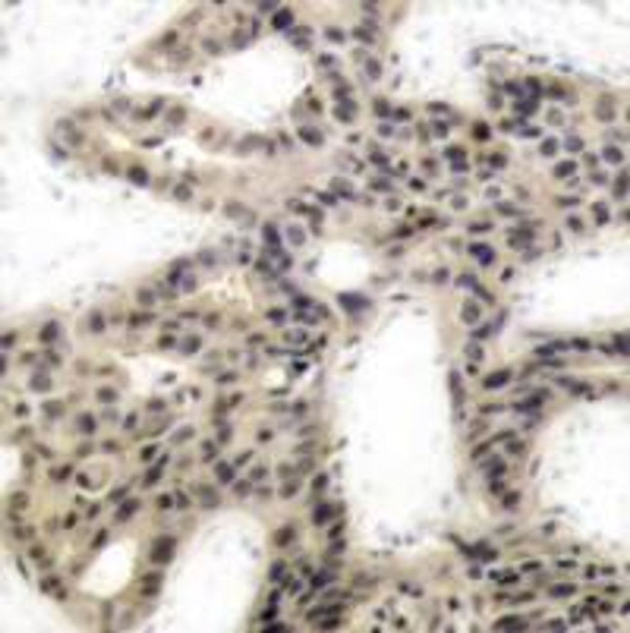 Immunohistochemical analysis of paraffin-embedded human breast carcinoma tissue using 4E-BP1 (Phospho-Thr45) .