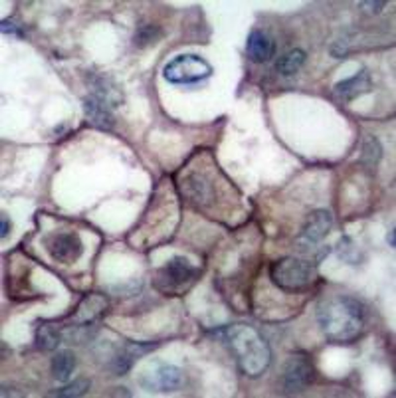 Immunohistochemical analysis of paraffin-embedded human breast carcinoma tissue using EGFR (Phospho-Tyr1197) .