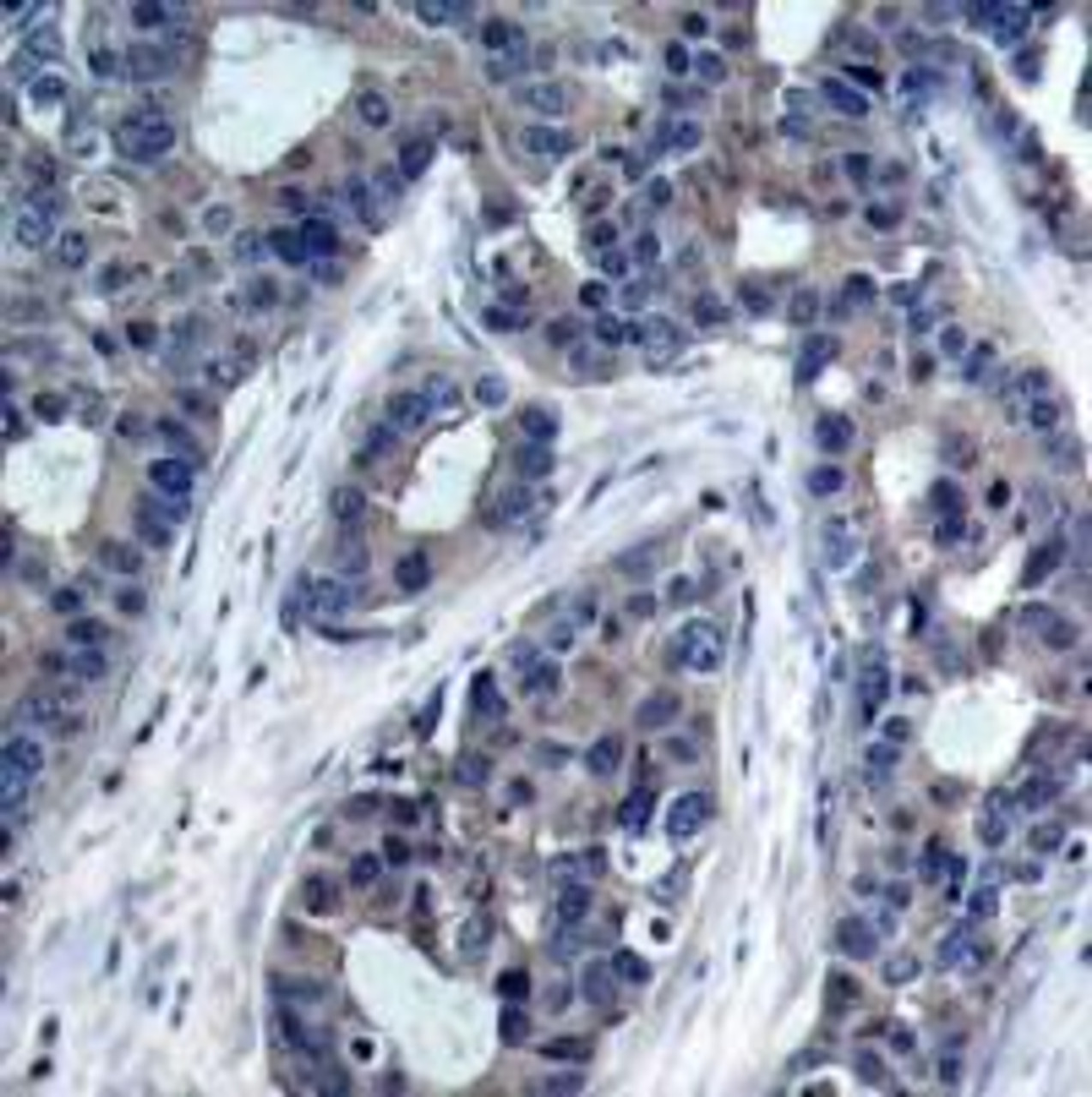 Immunohistochemical analysis of paraffin-embedded human breast carcinoma tissue using IRS-1 (Phospho-Ser636) .