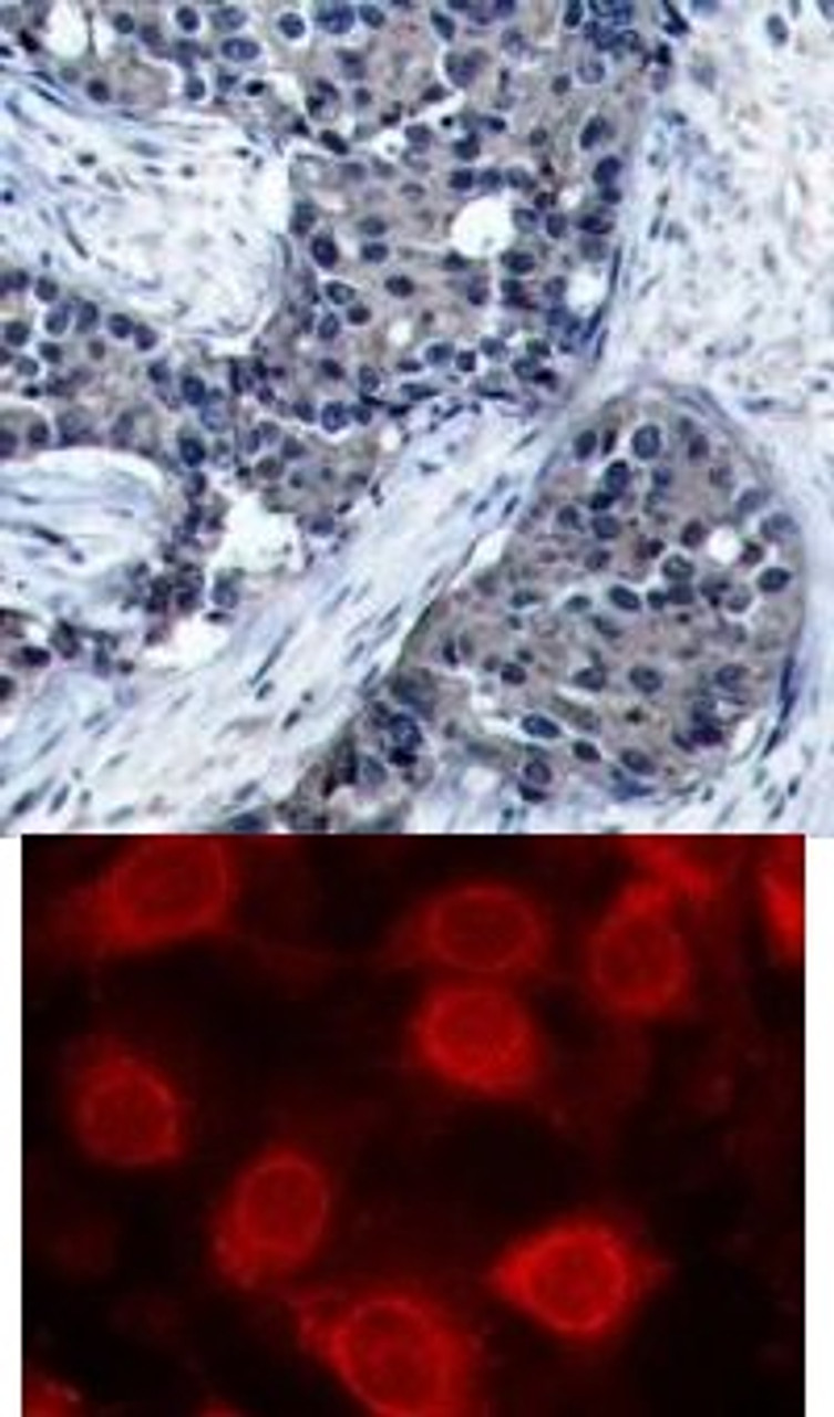 <b>Top Image:</b> Immunohistochemical analysis of paraffin-embedded human breast carcinoma tissue using eIF4E (Phospho-Ser209) .<b>Bottom Image:</b> Immunofluorescence staining of methanol-fixed MCF cells using eIF4E (Phospho-Ser209) .
