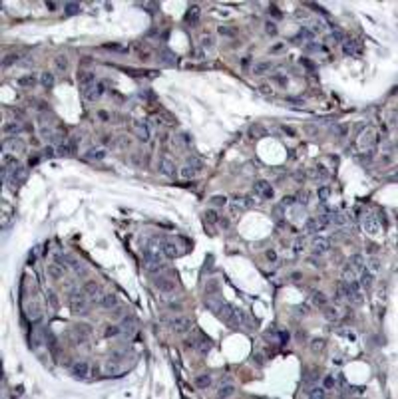 Immunohistochemical analysis of paraffin-embedded human breast carcinoma tissue using HSP27 (Phospho-Ser82) .