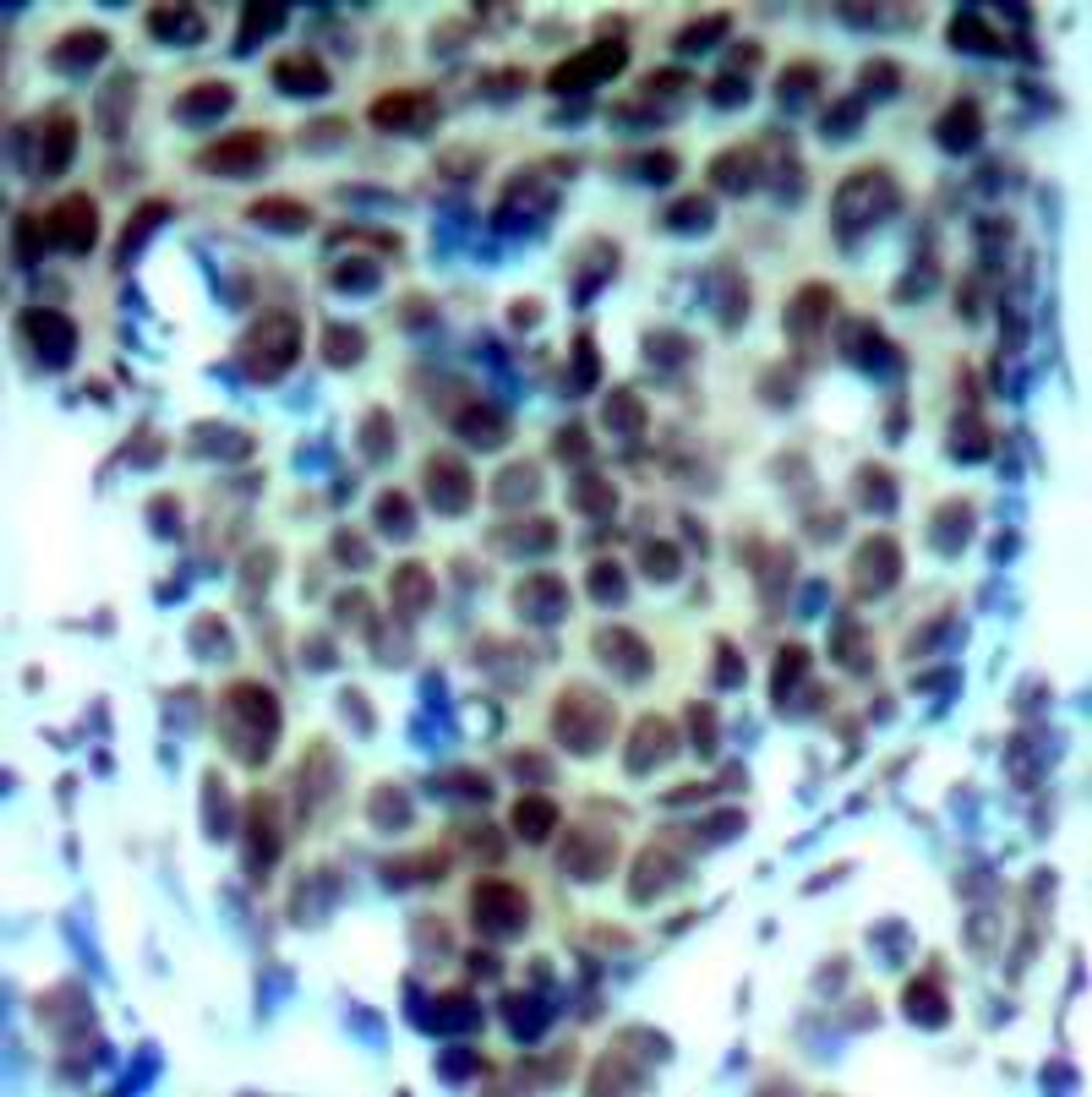 Immunohistochemical analysis of paraffin-embedded human breast carcinoma tissue using P38 MAPK (Phospho-Thr180) .