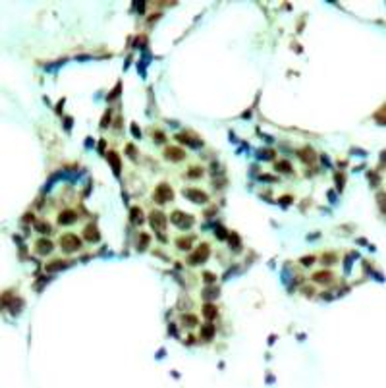 Immunohistochemical analysis of paraffin-embedded human breast carcinoma tissue using P38 MAPK (Phospho-Tyr182) .