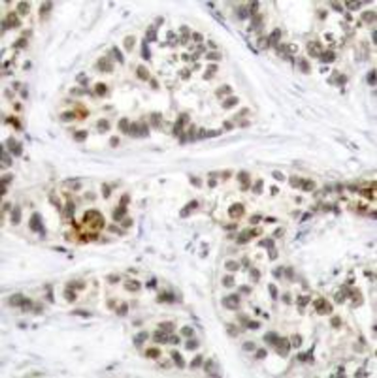 Immunohistochemical analysis of paraffin-embedded human breast carcinoma tissue using RelB (Phospho-Ser573) .