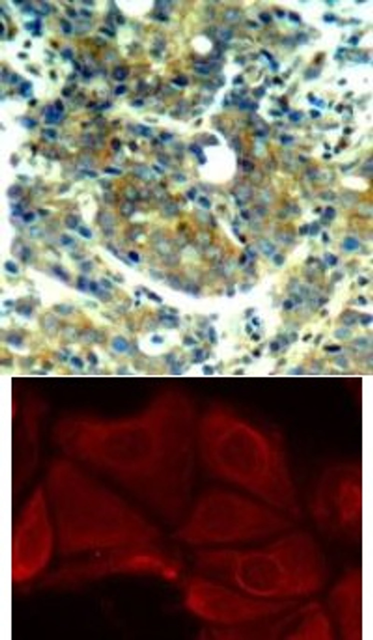 <b>Top Image:</b> Immunohistochemical analysis of paraffin-embedded human breast carcinoma tissue using p70 S6 Kinase (Phospho-Ser411) .<b>Bottom Image:</b> Immunofluorescence staining of methanol-fixed MCF7 cells using p70 S6 Kinase (Phospho-Ser411) .