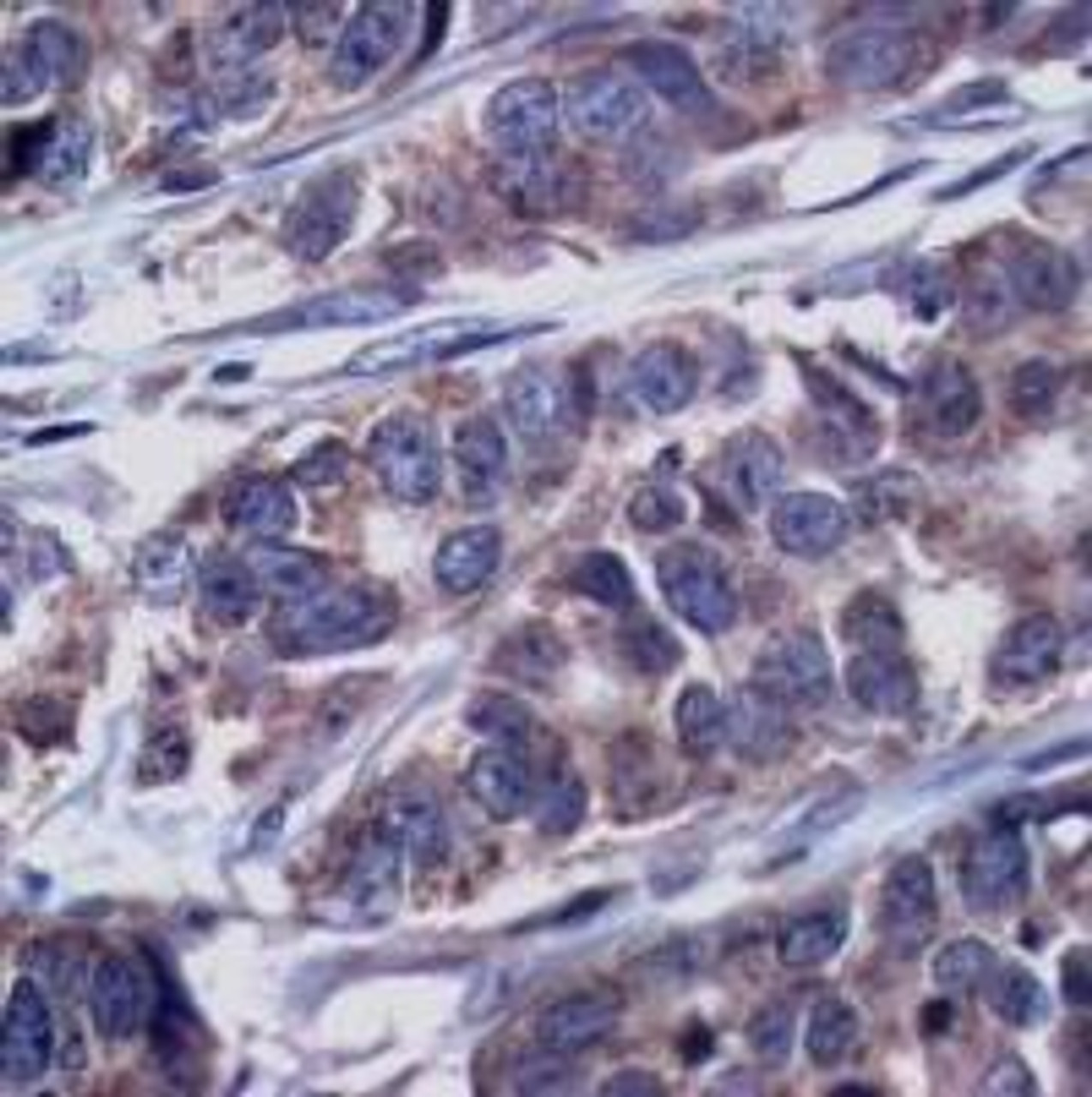 Immunohistochemical analysis of paraffin-embedded human breast carcinoma tissue using p62Dok (Phospho-Tyr362) .