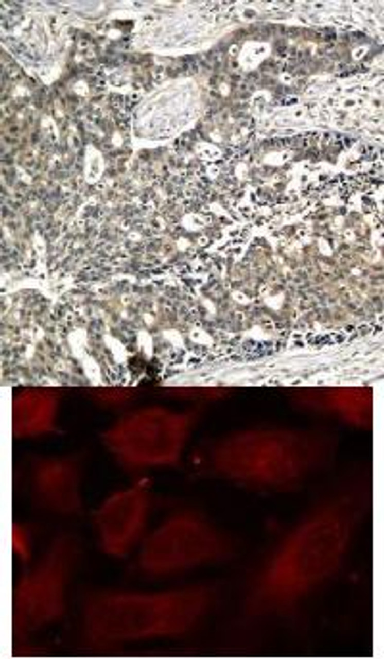 <b>Top Image:</b> Immunohistochemical analysis of paraffin-embedded human breast carcinoma tissue using p56Dok-2 (Phospho-Tyr299) .<b>Bottom Image:</b> Immunofluorescence staining of methanol-fixed HeLa cells using p56Dok-2 (Phospho-Tyr299) .