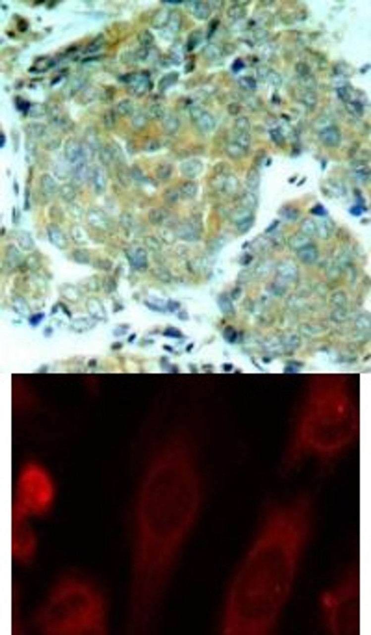 <b>Top Image:</b> Immunohistochemical analysis of paraffin-embedded human breast carcinoma tissue using eIF2&#945; (Phospho-Ser51) .<b>Bottom Image:</b> Immunofluorescence staining of methanol-fixed HeLa cells using eIF2&#945; (Phospho-Ser51) .