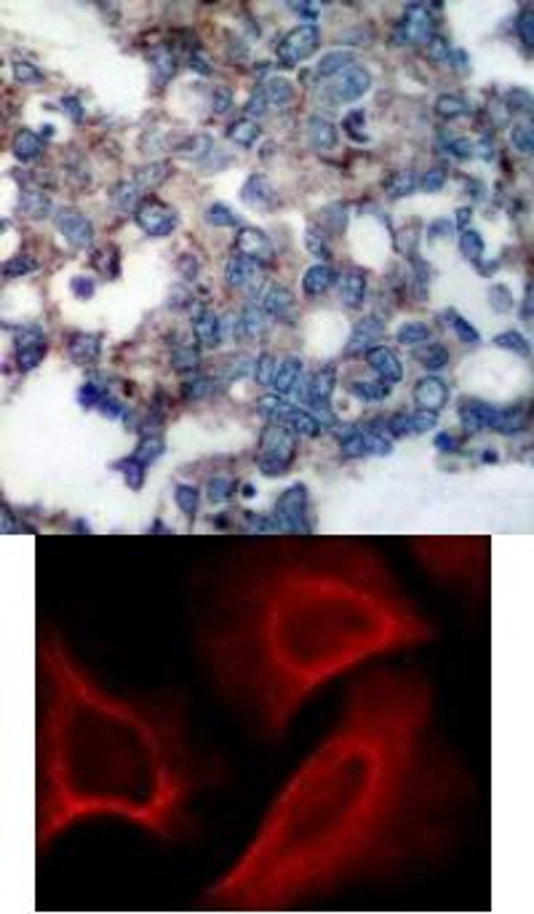 <b>Top Image:</b> Immunohistochemical analysis of paraffin-embedded human breast carcinoma tissue using p70 S6 Kinase (Phospho-Ser424) .<b>Bottom Image:</b> Immunofluorescence staining of methanol-fixed HeLa cells showing cytoplasmic, centrosomal and nuclear staining using p70 S6 Kinase (Phospho-Ser424) .