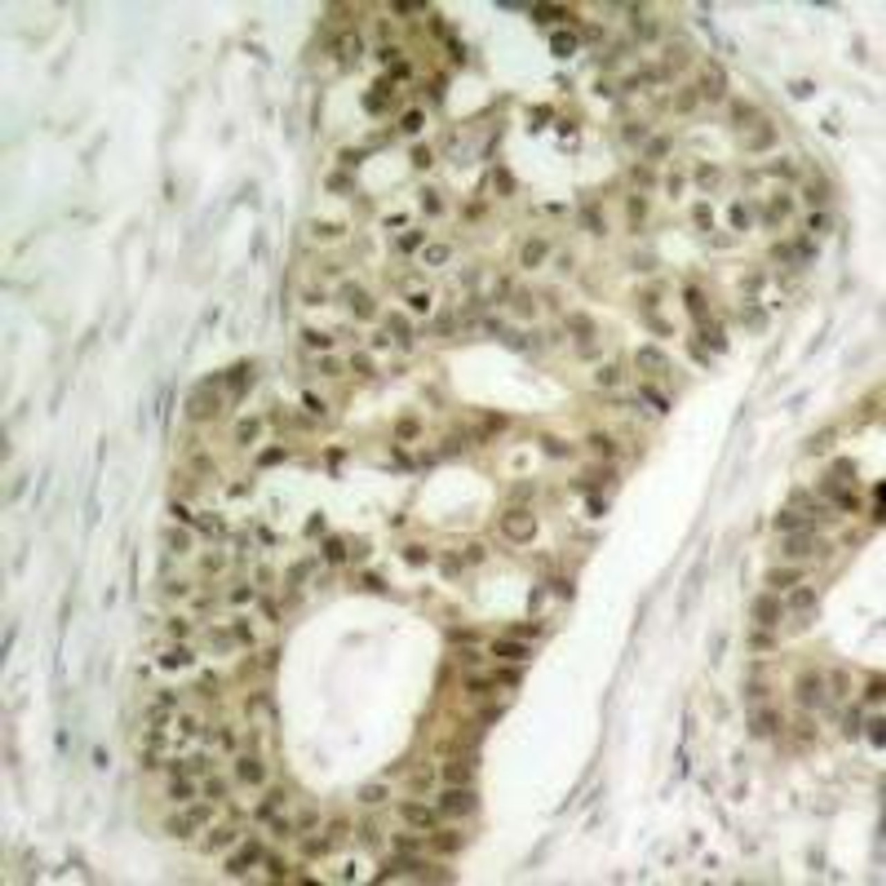 Immunohistochemical analysis of paraffin-embedded human breast carcinoma tissue using PKC&#948; (Phospho-Ser645) .
