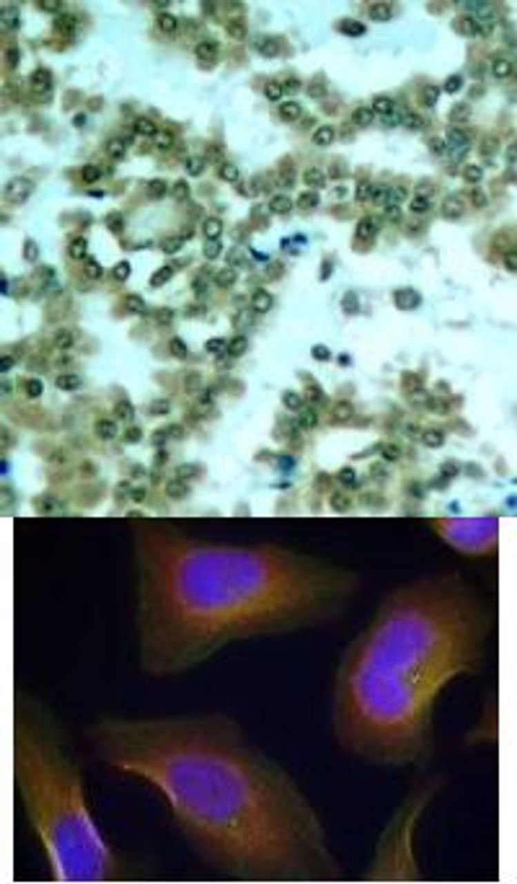 <b>Top Image:</b> Immunohistochemical analysis of paraffin-embedded human lung carcinoma tissue using PKC&#920; (Phospho-Ser676) .<b>Bottom Image:</b> Immunofluorescence staining of methanol-fixed HeLa cells using PKC&#920; (Phospho-Ser676) .