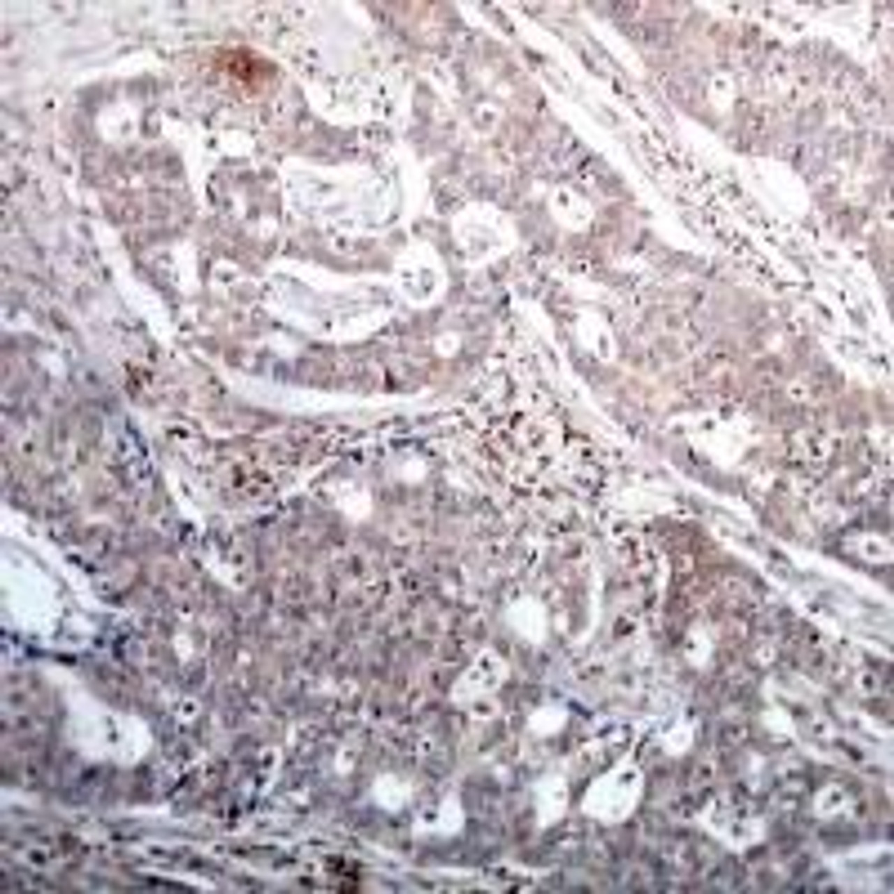 Immunohistochemical analysis of paraffin-embedded human breast carcinoma tissue using IkappaB-&#946; (Phospho-Ser23) .