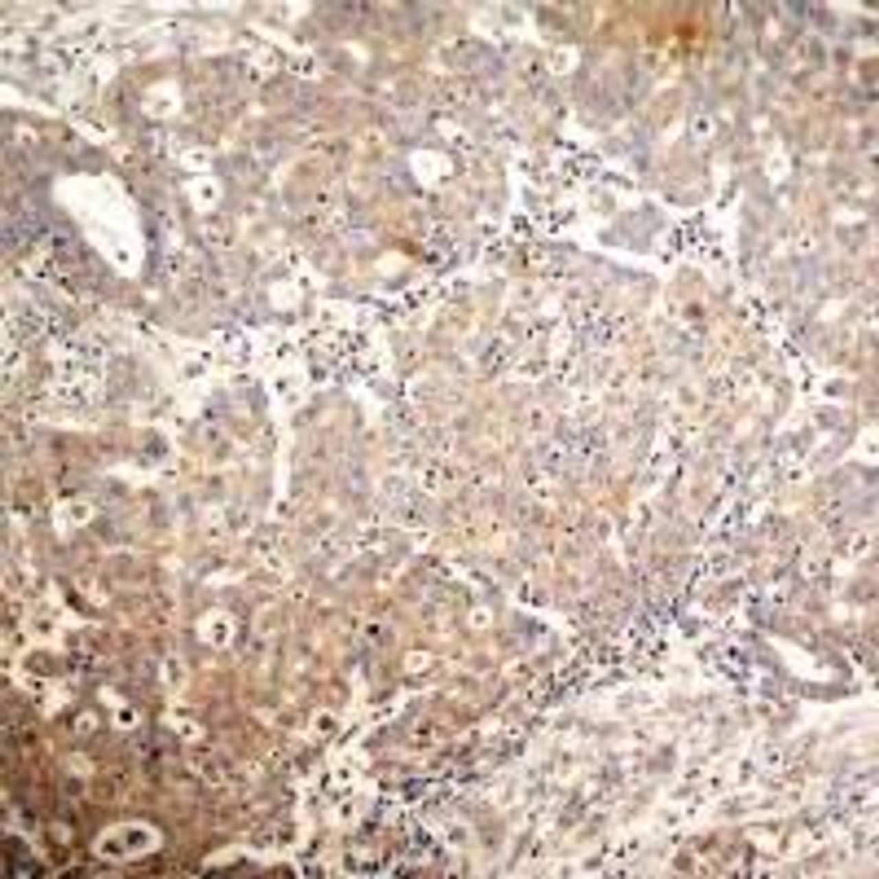 Immunohistochemical analysis of paraffin-embedded human breast carcinoma tissue using Keratin 18 (Phospho-Ser33) .