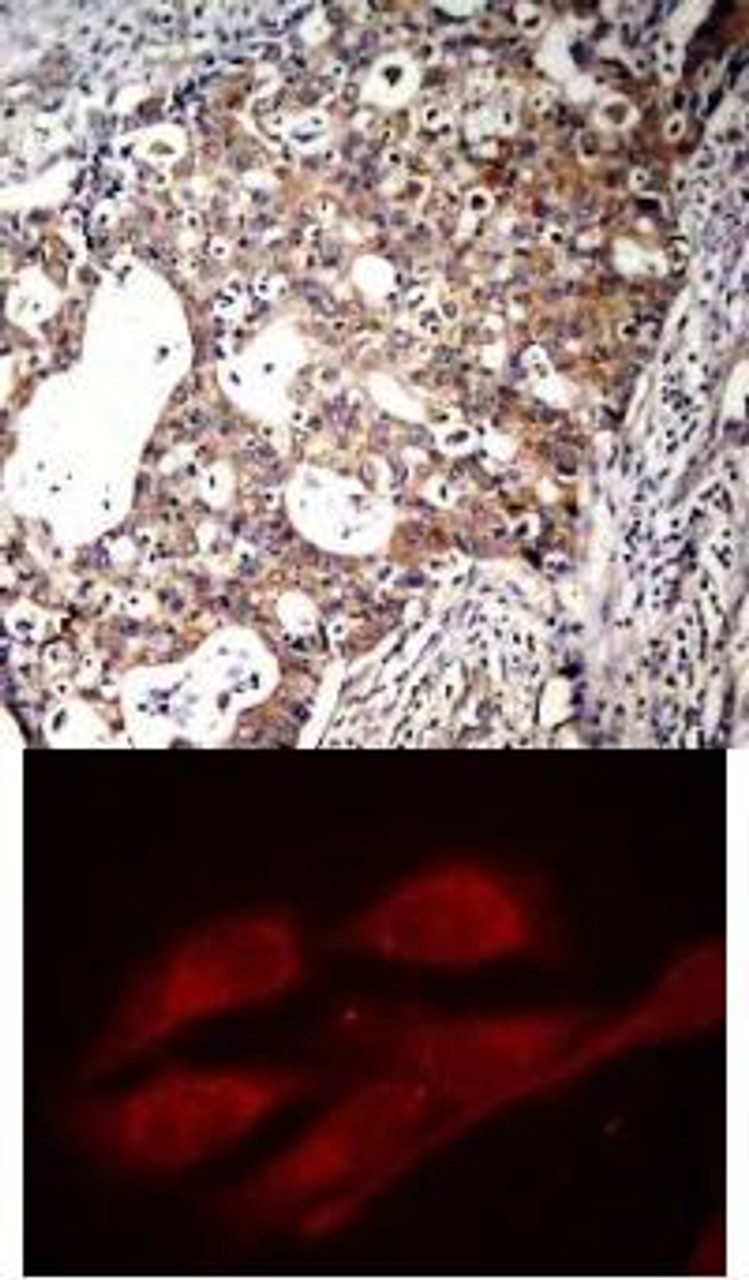 <b>Top Image:</b> Immunohistochemical analysis of paraffin-embedded human breast carcinoma tissue using Shc1 (Phospho-Tyr427) .<b>Bottom Image:</b> Immunofluorescence staining of methanol-fixed HeLa cells using Shc1 (Phospho-Tyr427) .