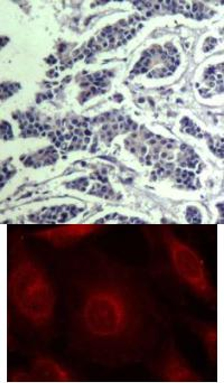 <b>Top Image:</b> Immunohistochemical analysis of paraffin-embedded human breast carcinoma tissue using AKT1/AKT2/AKT3 (Phospho-Tyr315/316/312) .<b>Bottom Image:</b> Immunofluorescence staining of methanol-fixed HeLa cells using AKT1/AKT2/AKT3 (phospho-Tyr315/316/312) .