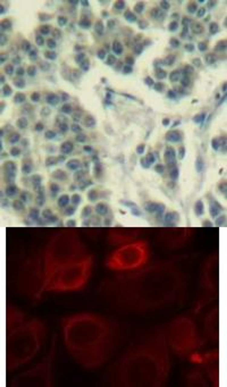 <b>Top Image:</b> Immunohistochemical analysis of paraffin-embedded human breast carcinoma tissue using Her3/ErbB3 (Phospho-Tyr1328) .<b>Bottom Image:</b> Immunofluorescence staining of methanol-fixed MCF7 cells using Her3/ErbB3 (phospho-Tyr1328) .