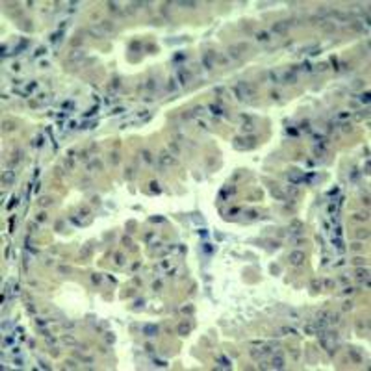 Immunohistochemical analysis of paraffin-embedded human lung carcinoma tissue using eIF4G (Phospho-Ser1232) .