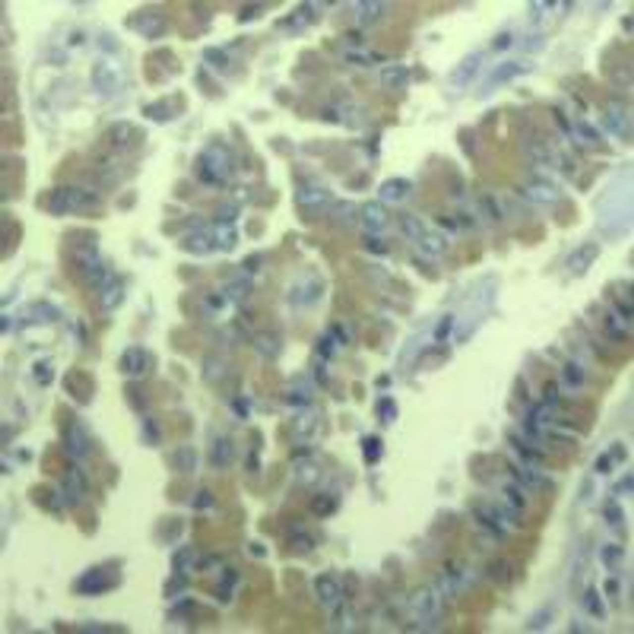 Immunohistochemical analysis of paraffin-embedded human lung carcinoma tissue using MARCKS (Phospho-Ser170) .
