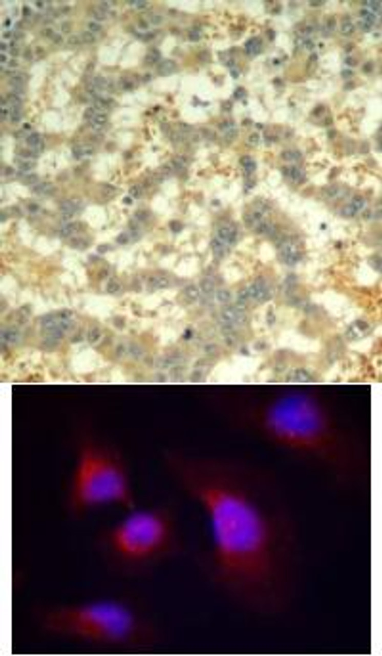 <b>Top Image:</b> Immunohistochemical analysis of paraffin-embedded human breast carcinoma tissue using syk (Phospho-Tyr323) .<b>Bottom Image:</b> Immunofluorescence staining of methanol-fixed HeLa cells using syk (phospho-Tyr323) .