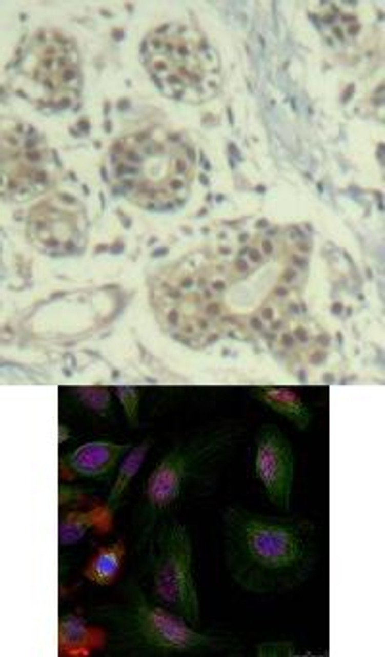 <b>Top Image:</b> Immunohistochemical analysis of paraffin-embedded human breast carcinoma tissue using MDM2 (Phospho-Ser166) .<b>Bottom Image:</b> Immunofluorescence staining of methanol-fixed HeLa cells using MDM2 (phospho-Ser166) .