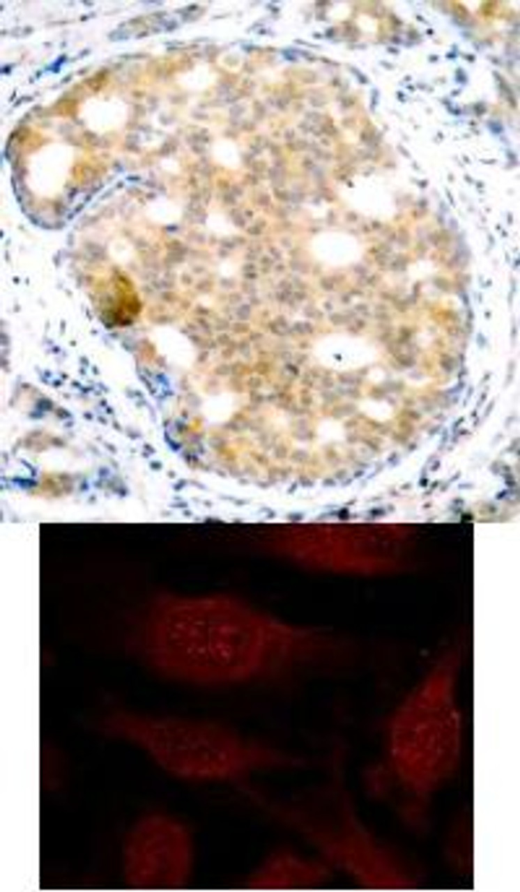 <b>Top Image:</b> Immunohistochemical analysis of paraffin-embedded human breast carcinoma tissue using GSK3&#946; (Ab-9) .<b>Bottom Image:</b> Immunofluorescence staining of methanol-fixed HeLa cells showing cytoplasmic and nuclear staining using GSK3&#946; (Ab-9) .
