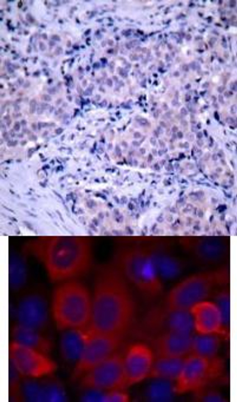 <b>Top Image:</b> Immunohistochemical analysis of paraffin-embedded human breast carcinoma tissue using PDK1 (Ab-241) .<b>Bottom Image:</b> Immunofluorescence staining of methanol-fixed MCF7 cells using PDK1 (Ab-241) .