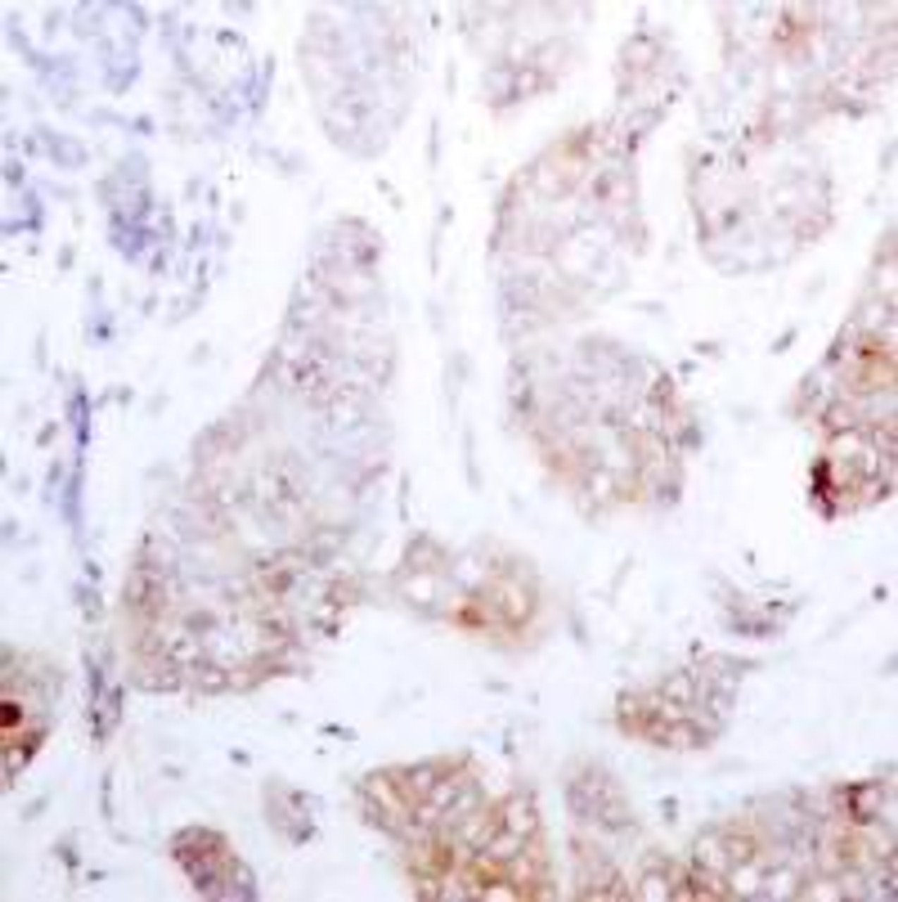 Immunohistochemical analysis of paraffin-embedded human breast carcinoma tissue using Raf1 (Ab-259) .