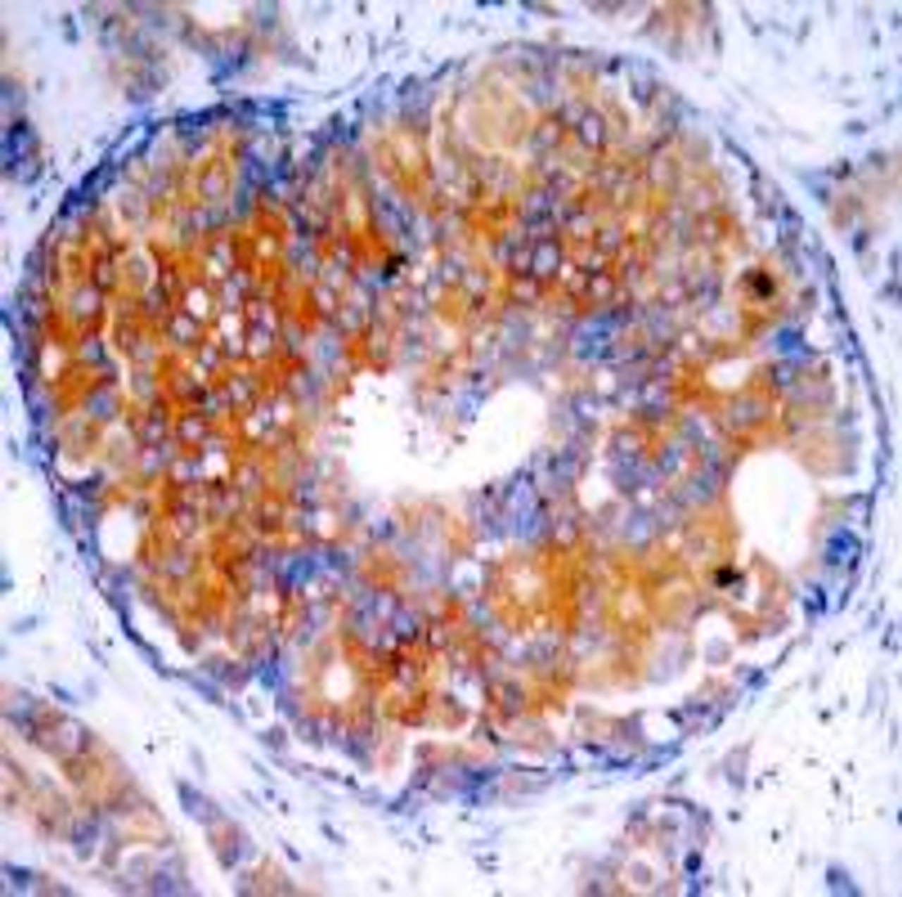 Immunohistochemical analysis of paraffin-embedded human breast carcinoma tissue using MEK-2 (Ab-394) .