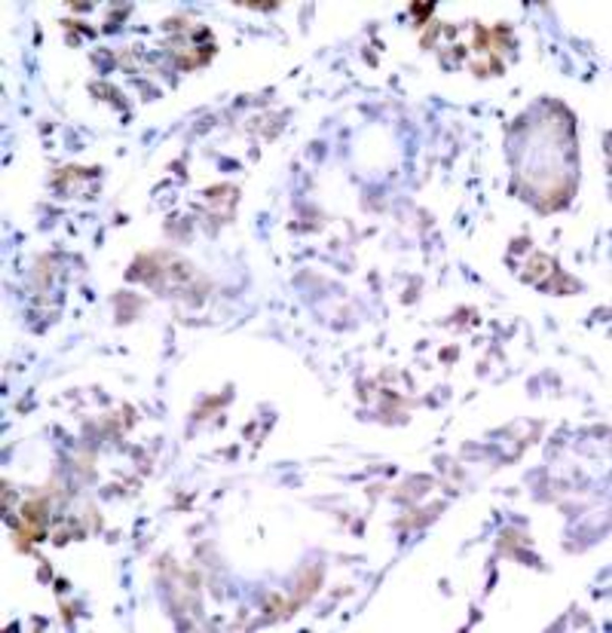 Immunohistochemical analysis of paraffin-embedded human breast carcinoma tissue using NF&#954;B-p65 (Ab-254) .