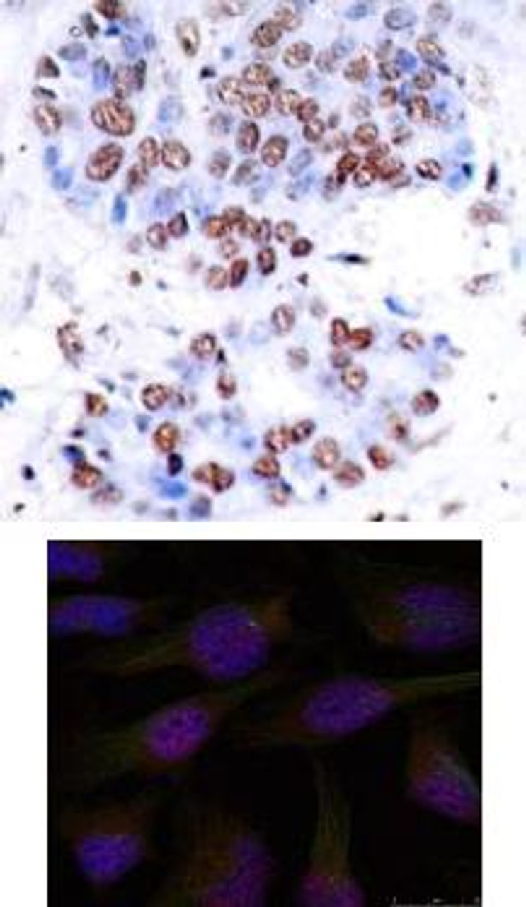 <b>Top Image:</b> Immunohistochemical analysis of paraffin-embedded human breast carcinoma tissue using NF&#954;B-p65 (Ab-276) .<b>Bottom Image:</b> Immunofluorescence staining of methanol-fixed HeLa cells using NF&#954;B-p65 (Ab-276) .