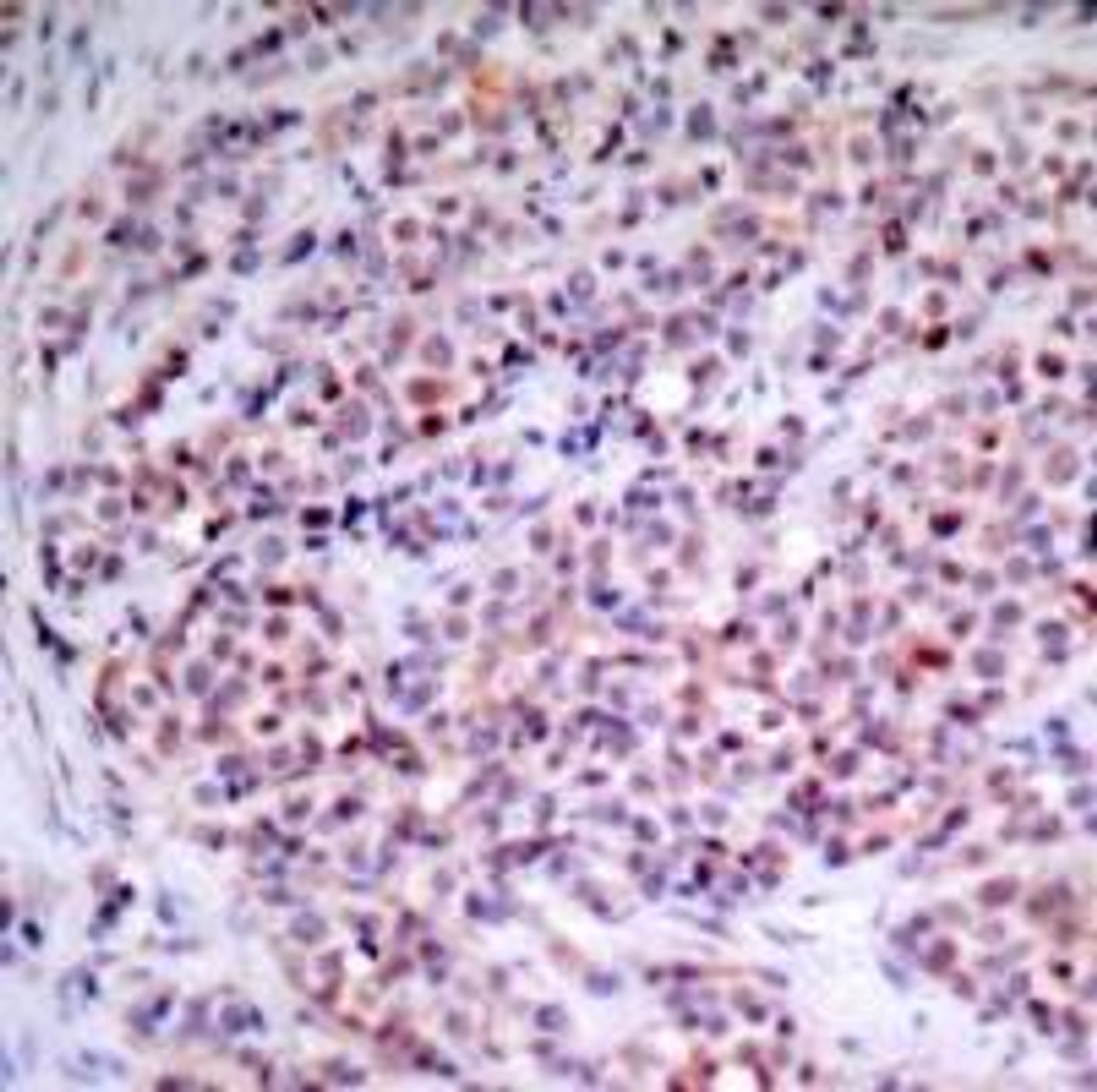 Immunohistochemical analysis of paraffin-embedded human breast carcinoma tissue using NF&#954;B -p65 (Ab-435) .