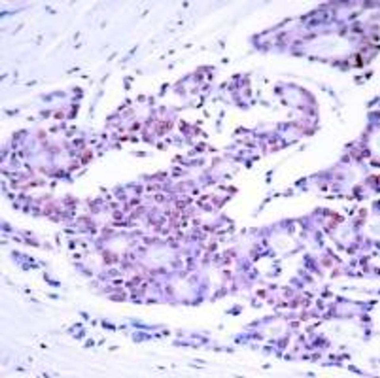 Immunohistochemical analysis of paraffin-embedded human breast carcinoma tissue using NF&#954;B-p65 (Ab-468) .