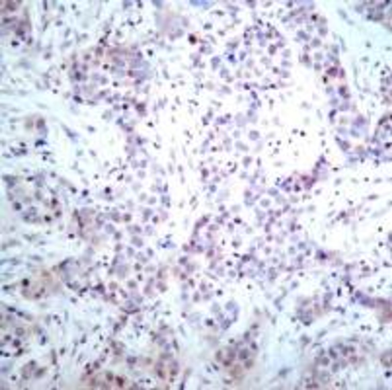 Immunohistochemical analysis of paraffin-embedded human breast carcinoma tissue using NF&#954;B-p65 (Ab-536) .