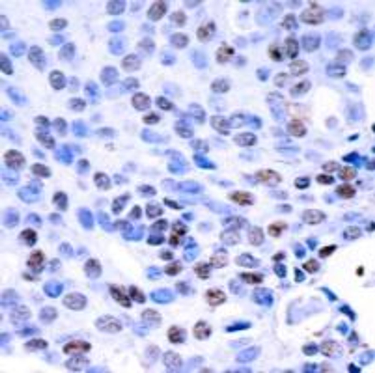 Immunohistochemical analysis of paraffin-embedded human breast carcinoma tissue using NF&#954;B-p105/p50 (Ab-337) .