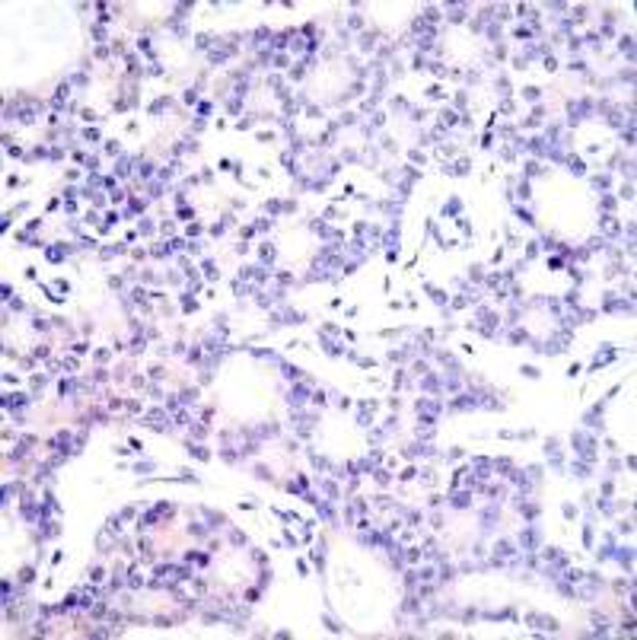 Immunohistochemical analysis of paraffin-embedded human breast carcinoma tissue using NF&#954;B-p105/p50 (Ab-893) .