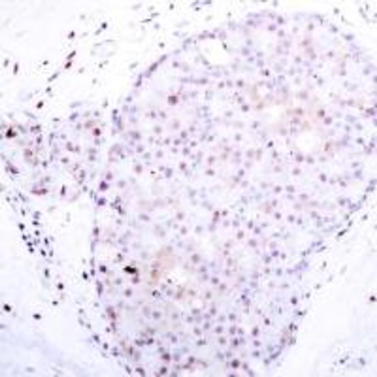 Immunohistochemical analysis of paraffin-embedded human breast carcinoma tissue using NF&#954;B-p105/p50 (Ab-907) .
