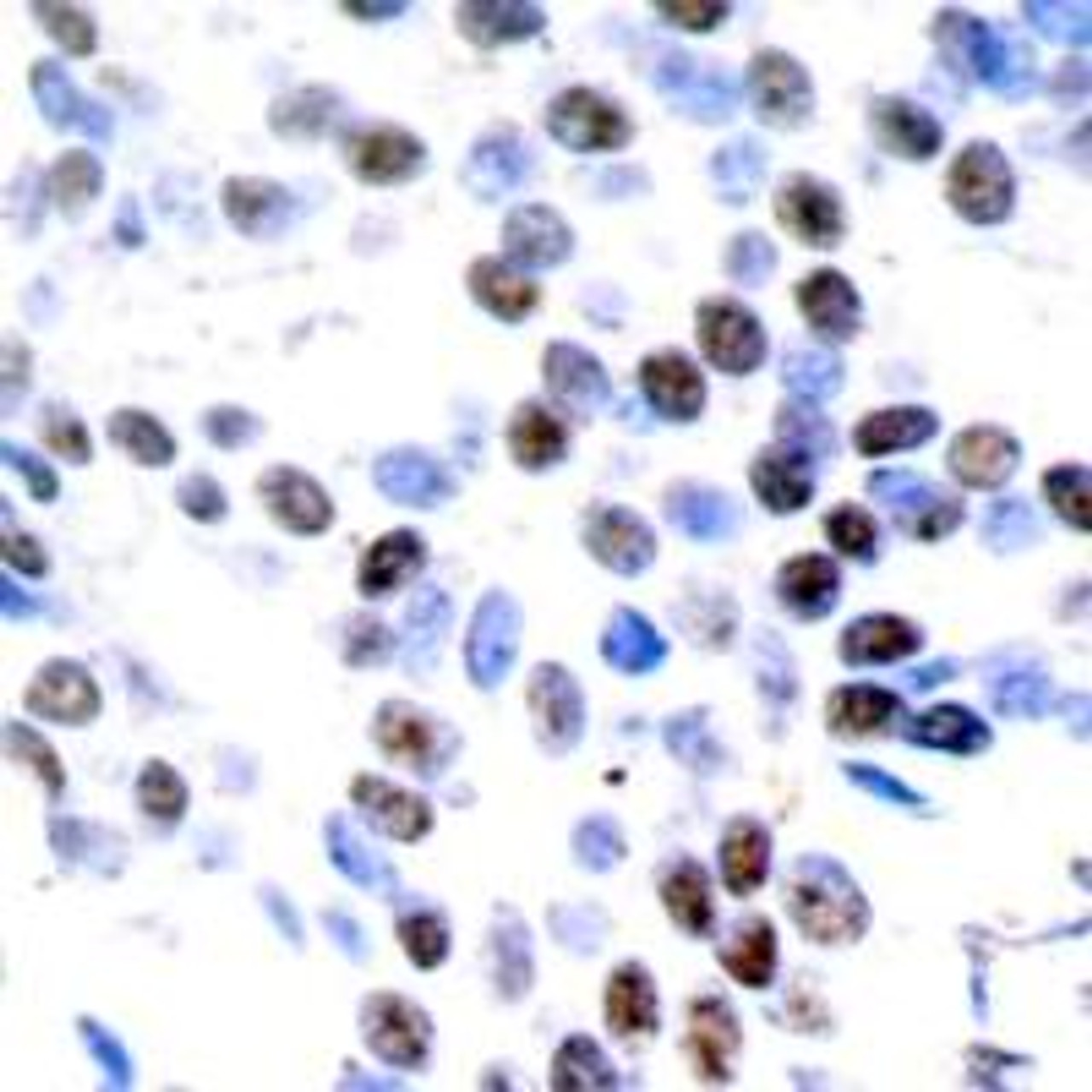 Immunohistochemical analysis of paraffin-embedded human breast carcinoma tissue using c-Jun (Ab-93) .