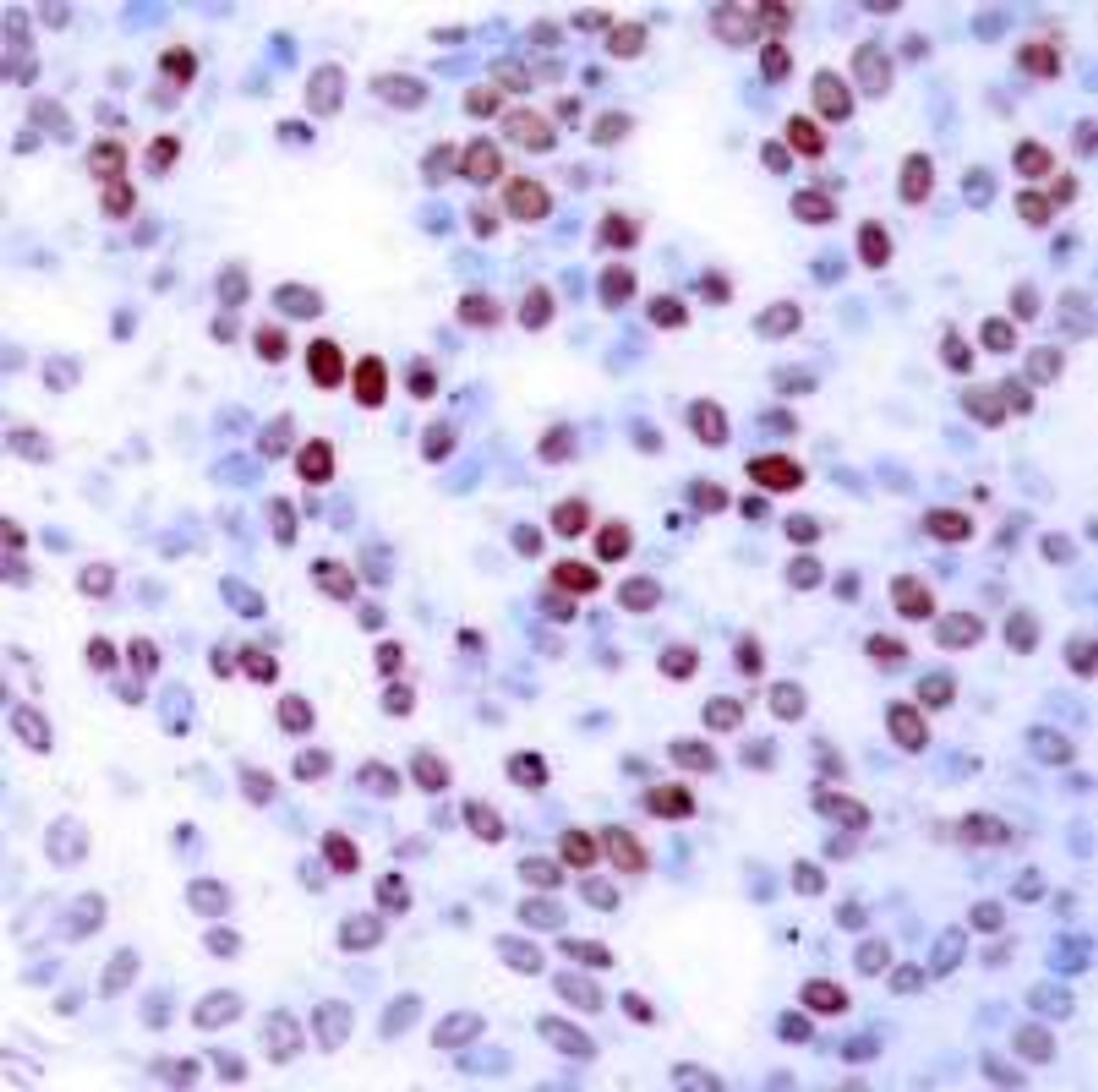 Immunohistochemical analysis of paraffin-embedded human breast carcinoma tissue using c-Jun (Ab-243) .