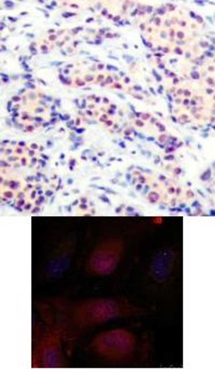 <b>Top Image:</b> Immunohistochemical analysis of paraffin-embedded human breast carcinoma tissue using JunD (Ab-255) .<b>Bottom Image:</b> Immunofluorescence staining of methanol-fixed HeLa cells using JunD (Ab-255) .