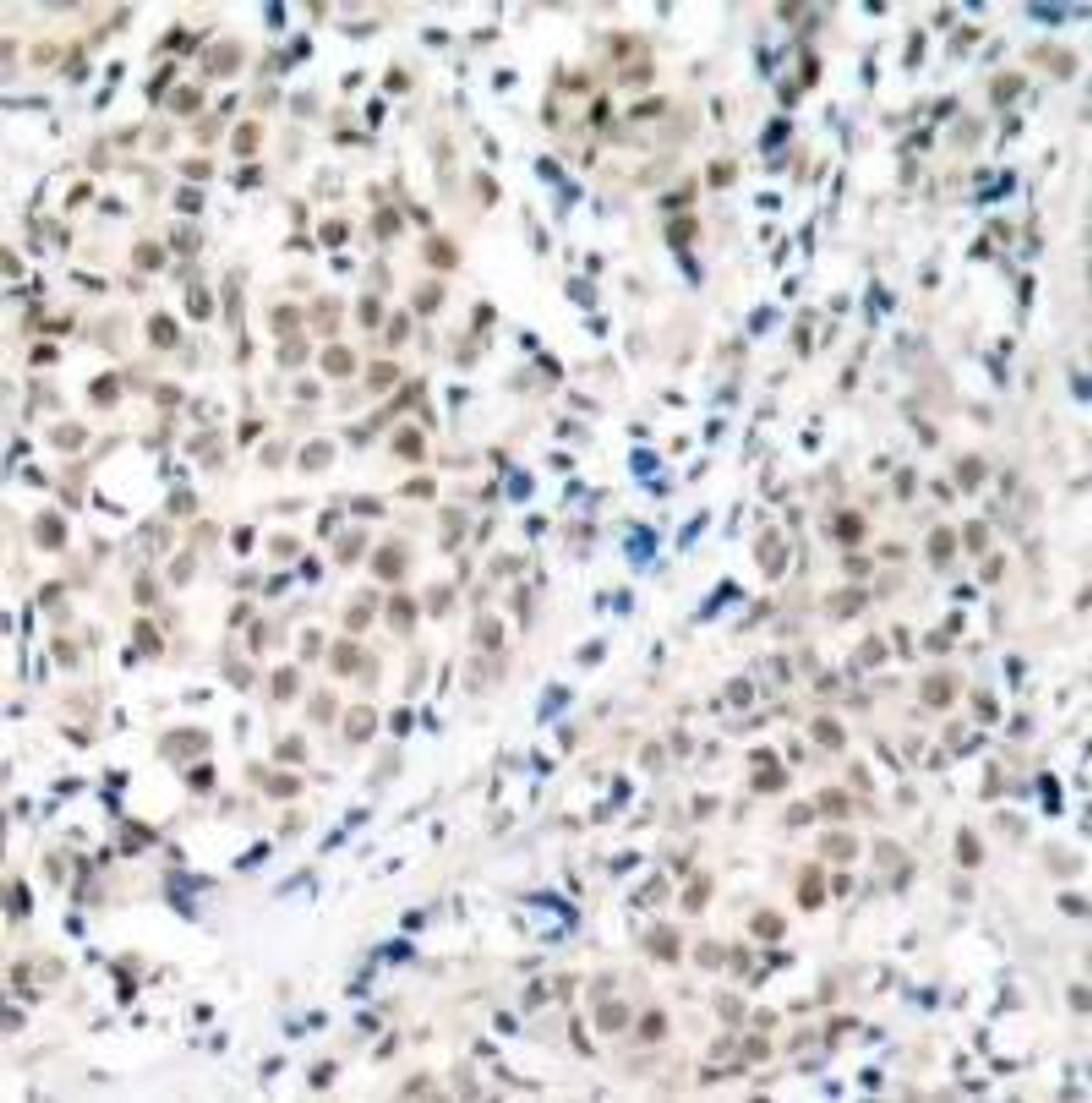 Immunohistochemical analysis of paraffin-embedded human breast carcinoma tissue using Myc (Ab-358) .