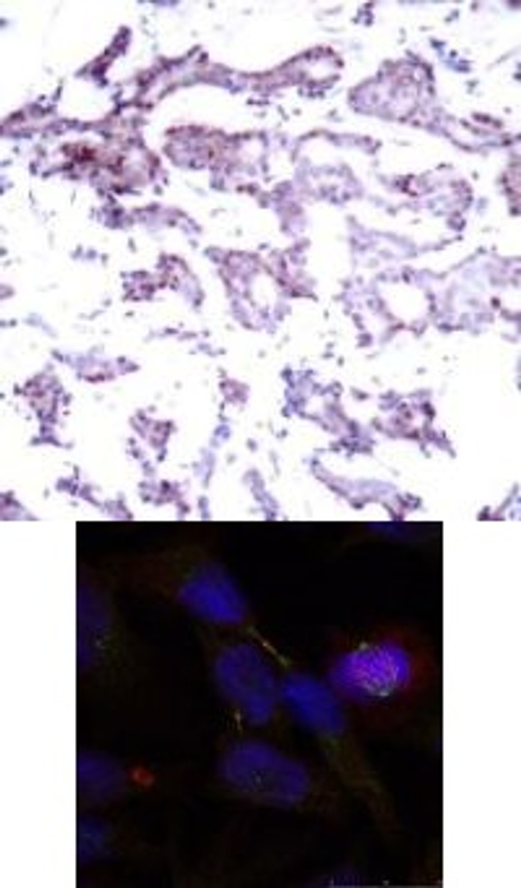 <b>Top Image:</b> Immunohistochemical analysis of paraffin-embedded human breast carcinoma tissue using Elk1 (Ab-389) .<b>Bottom Image:</b> Immunofluorescence staining of methanol-fixed HeLa cells using Elk1 (Ab-389) .